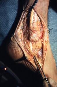 Natural color photograph of dissection of the right ankle, lateral view, with the foreceps pinching the lateral dorsal cutaneous n