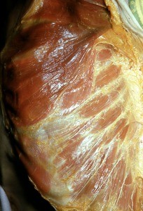 Natural color photograph of dissection of the right thoracic wall, anteriorlateral view, with skin removed to expose the external abdominal oblique muscles and lateral cutaneous branches of intercostal nerves