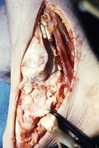 Natural color photograph of dissection of the right ankle, medial view