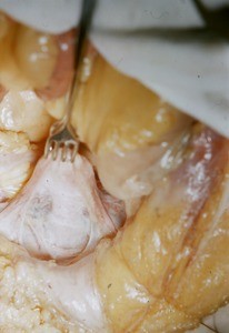 Natural color photograph of dissection of the pelvic cavity, superior view, with the uterus retracted posteriorly to expose the vesicouterine pouch