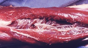 Natural color photograph of dissection of the right forearm, posterior view, showing the deep branch of the radial nerve as it exits from beneath the supinator muscle