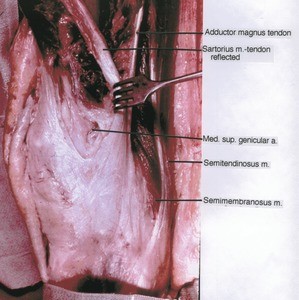 Natural color photograph of right knee, anteromedial view, showing tendons, muscle and artery with the Sartorius tendon retracted