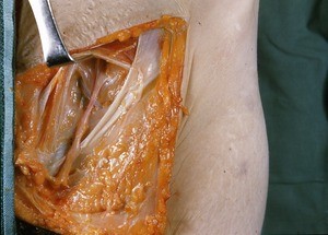 Natural color photograph of dissection of the left inguinal region, anterior view