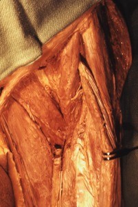 Natural color photograph of dissection of the left femur, showing cut ends of the deep and superficial femoral arteries and the femoral vein, along with associated musculature