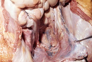 Natural color photograph of dissection of the pelvic cavity, anterior view, showing the pelvic viscera and mesentery