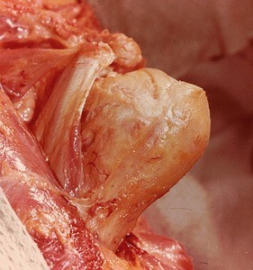 Natural color photograph of dissection of the left shoulder, anterior view, with muscles of the arm removed to reveal the head of the humerus