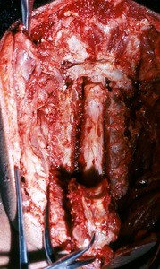 Natural color photograph of dissection of the spinal cord, posterior view