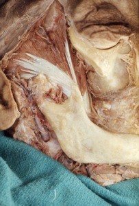 Natural color photograph of dissection of the face, right lateral view, showing the insertion of the temporalis muscle onto the mandible