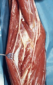 Natural color photograph of dissection of the left forearm, showing the ulnar n., the median n., and the deep and superficial branches of the radial n