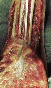 Natural color photograph of dissection of the left forearm, anterior view