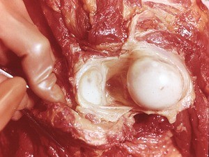 Natural color photograph of dissection of the shoulder, with the muscles and fibrous joint capsule retracted to expose the glenoid cavity of the scapula and the head of the humerus