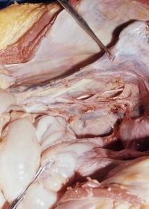 Natural color photograph of the pelvic cavity, anterior view, showing the rectouterine pouch with the peritoneum removed to expose the underlying vessels, nerves, and ureter