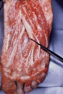 Natural color photograph of dissection of the plantar surface of the right foot, with the flexor hallucis brevis muscle retracted to expose the flexor hallucis longus muscle