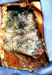 Natural color photograph of dissection of the right thorax, anterior view, with the ribs removed to expose the right lung