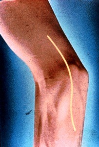 Illustration of surface anatomy of right elbow joint in partial flexion; medial view; yellow line indicates incision for surgical exposure of ulnar nerve