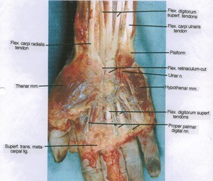Natural color photograph of dissection of right hand, anterior view, showing tendons, ligament, bone, nerves and muscles