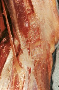 Natural color photograph of dissection of the right knee, lateral view, showing the biceps femoris muscle and a portion of the iliotibial tract