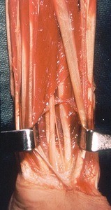 Natural color photograph of dissection of the left forearm, anterior view, showing tendons of the flexor digitorum superficialis muscle