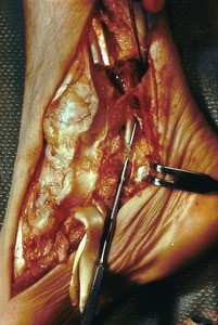 Natural color photograph of dissection of the right foot, medial view, with the tibialis posterior and flexor digitorum longus tendons reflected and a probe passing through the tendinous sheath of the flexor hallucis longus