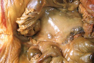 Natural color photograph of the lower abdominal cavity, anterior view, showing the ascending colon, descending colon, sigmoid colon, and rectum