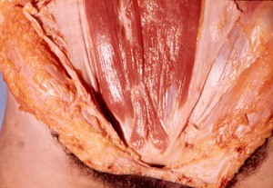 Natural color photograph of dissection of the lower abdominal wall, anterior view, showing the pyramidalis m. and the rectus abdominis m