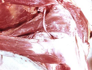 Natural color photograph of dissection of the left shoulder, posterior view, with the rotator cuff muscles removed to expose the axillary nerve