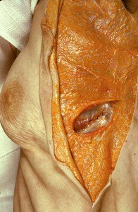 Natural color photograph of dissection of the right thorax, anterior view, with the skin and breast resected along the retromammary space