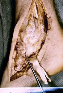 Natural color photograph of dissection of the right ankle, medial view, with the tibialis posterior t. and the flexor digitorum longus t. cut and reflected