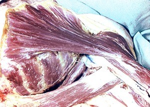 Natural color photograph of dissection of the left axilla, anterolateral view