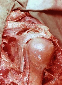 Natural color photograph of dissection of the left shoulder, lateral view, with the deltoid muscle reflected to expose the structures associated with the head and surgical neck of the humerus