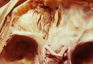 Natural color photograph of dissection of the middle and anterior cranial fossa, superior view, showing the optic nerve, internal carotid arteries and various nerves of the orbit