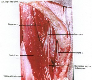 Natural color photograph of dissection of the femoral triangle, emphasizing the femoral nerve