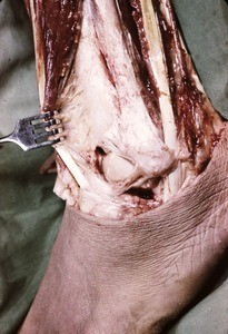 Natural color photograph of dissection of the left ankle, lateral view, exposing the fibula and related structures