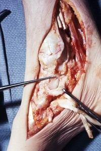 Natural color photograph of dissection of the right ankle, medial view, emphasizing the talus, with the tibialis posterior t. and flexor digatorum longus t. cut and reflected