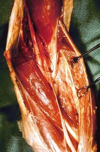 Natural color photograph of dissection of the left cubital fossa, with the median nerve tied