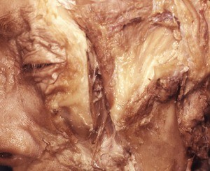 Natural color photograph of dissection of the face, left lateral view, with the zygomatic arch removed to expose the temporal fossa