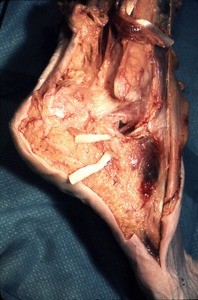 Natural color photograph of dissection of the right ankle, lateral view, with the fibularis longus t. and the fibularis brevis t. cut and reflected