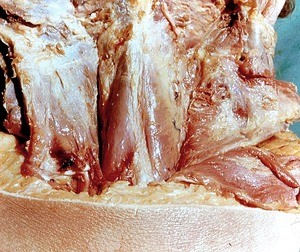 Natural color photograph of dissection of the neck, posterior view, with the superficial and intermediate layers of muscle reflected to expose the deep muscle layer of the neck