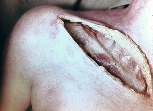 Natural color photograph of dissection of the thoracic wall, anterior view, overlying the right clavicle