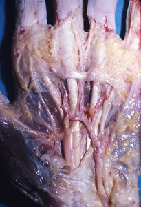 Natural color photograph of dissection of the palmar surface of the left hand, emphasizing the palmar arch