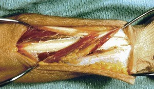 Natural color photograph of dissection of the forearm