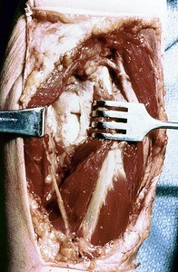 Natural color photograph of dissection of the forearm