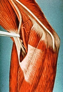 Illustration of right elbow, posteromedial view, showing biceps muscle & its aponeurosis (cut), medial nerve & brachial artery, and ulnar nerve (crossing medial epicondyle) and common flexor muscle group