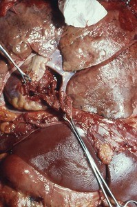 Natural color photograph of dissection of the thorax, anterior view, with the rib cage removed and an incision in the pericardium to expose cardiac tissue and a blood-filled pericardial sac