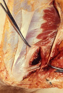 Natural color photograph of dissection of the abdominal wall, anterior view, showing the external abdominal oblique m., which has been incised and reflected