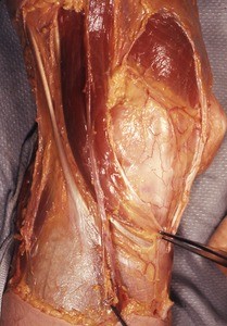 Natural color photograph of dissection of the left knee, medial view, showing muscles, tendons and vasculature