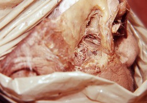 Photograph of dissection of the right orbit, posterolateral view