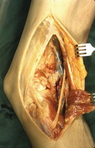 Natural color photograph of dissection of the right knee, medial view