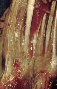 Natural color photograph of dissection of the forearm, anterior view