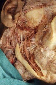 Photograph of dissection of the temporal fossa, right lateral view, emphasizing the branches of the maxillary artery, with part of the mandible removed to expose the inferior alveolar artery and nerve